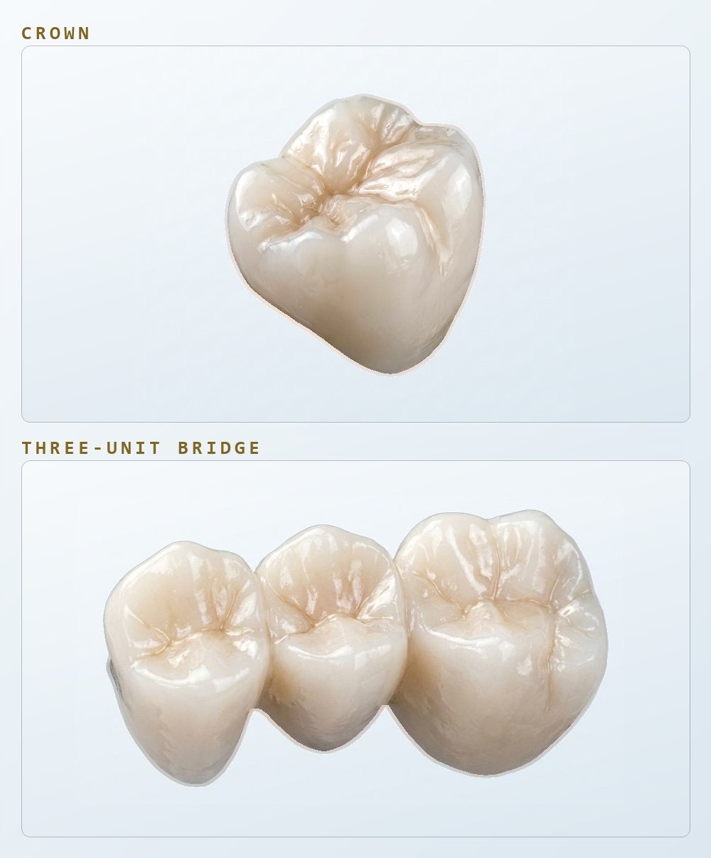 Two ceramic restorations pictured on a light ground, illustrating a single molar crown above and a three-unit bridge below.