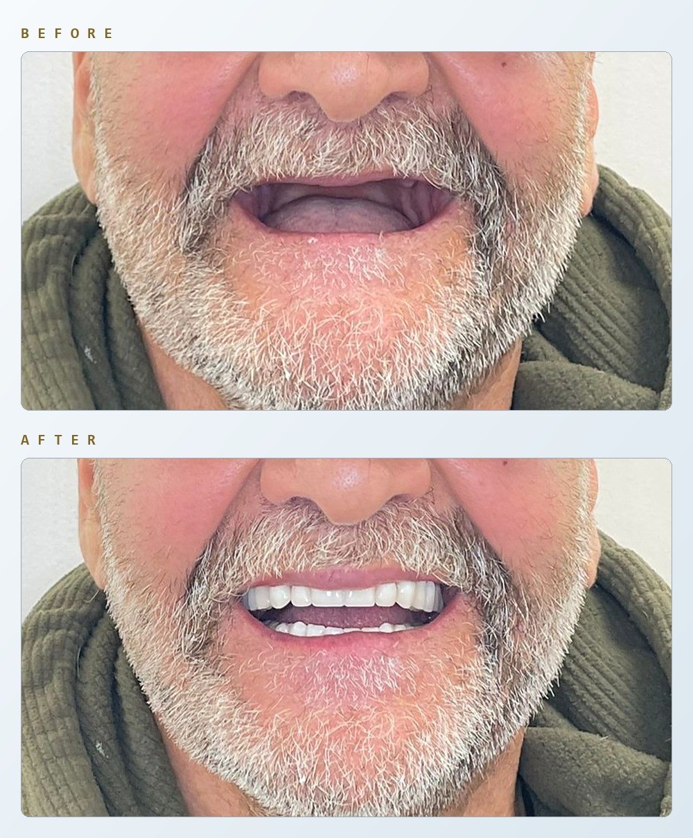 Before and after close-ups of the same patient’s mouth: above, with no upper teeth; below, smiling with a full set of denture teeth.