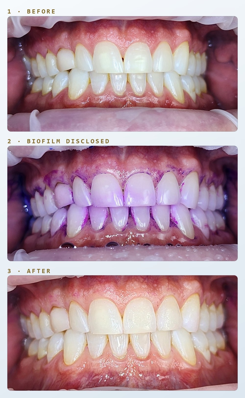 Three intraoral photographs of the same patient at one hygiene visit: before cleaning, after a disclosing solution has stained the biofilm purple, and after Guided Biofilm Therapy.