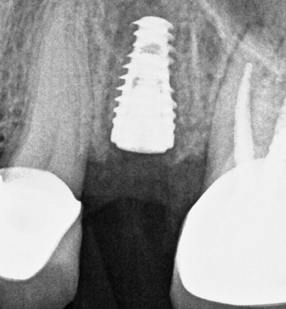 Dental X-rays of one patient: an implant at placement and the same implant with its final crown.