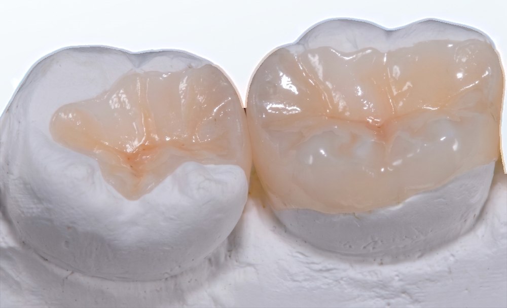 Two ceramic restorations pictured on a white stone model, illustrating an inlay on the left, sitting inside the cusps, and an onlay on the right, covering the cusps.