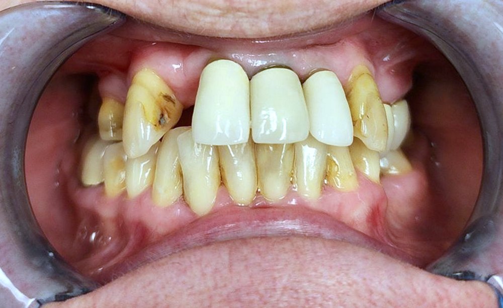 Before treatment: upper teeth with gaps where teeth are missing and several worn, discolored teeth, shown biting together with cheek retractors.